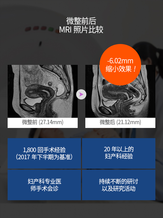 女性私密整形, 阴道整形 , 小阴唇整形 ,韩国女性整形, 韩国私密整形, 韩国江南妇产科